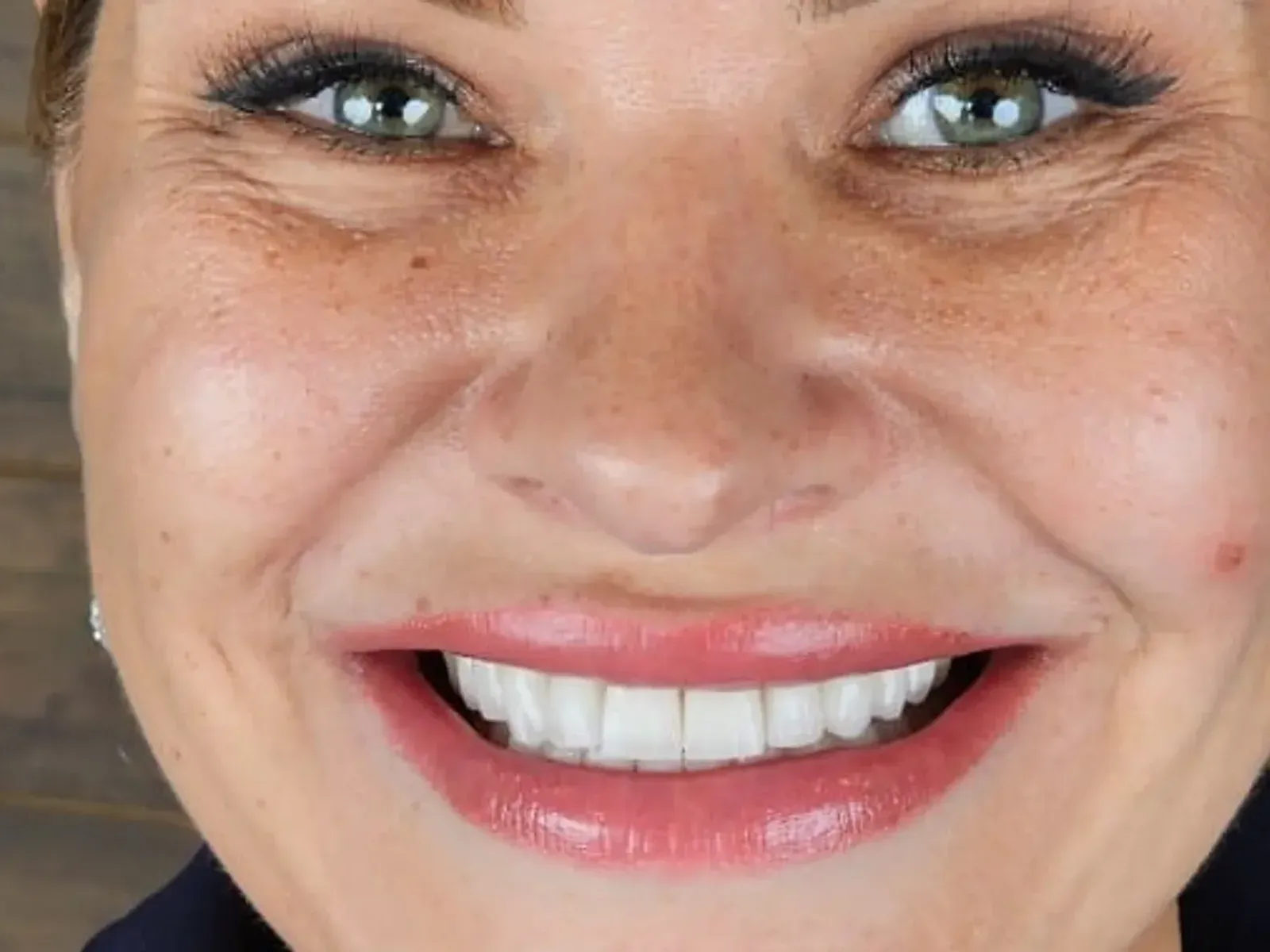Po Hollywood smile — przypadek z naszej kliniki