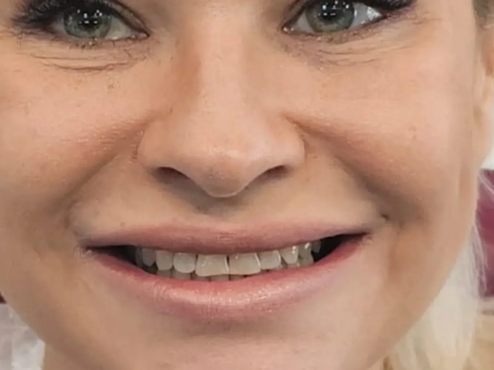 Przed Hollywood smile — przypadek z naszej kliniki