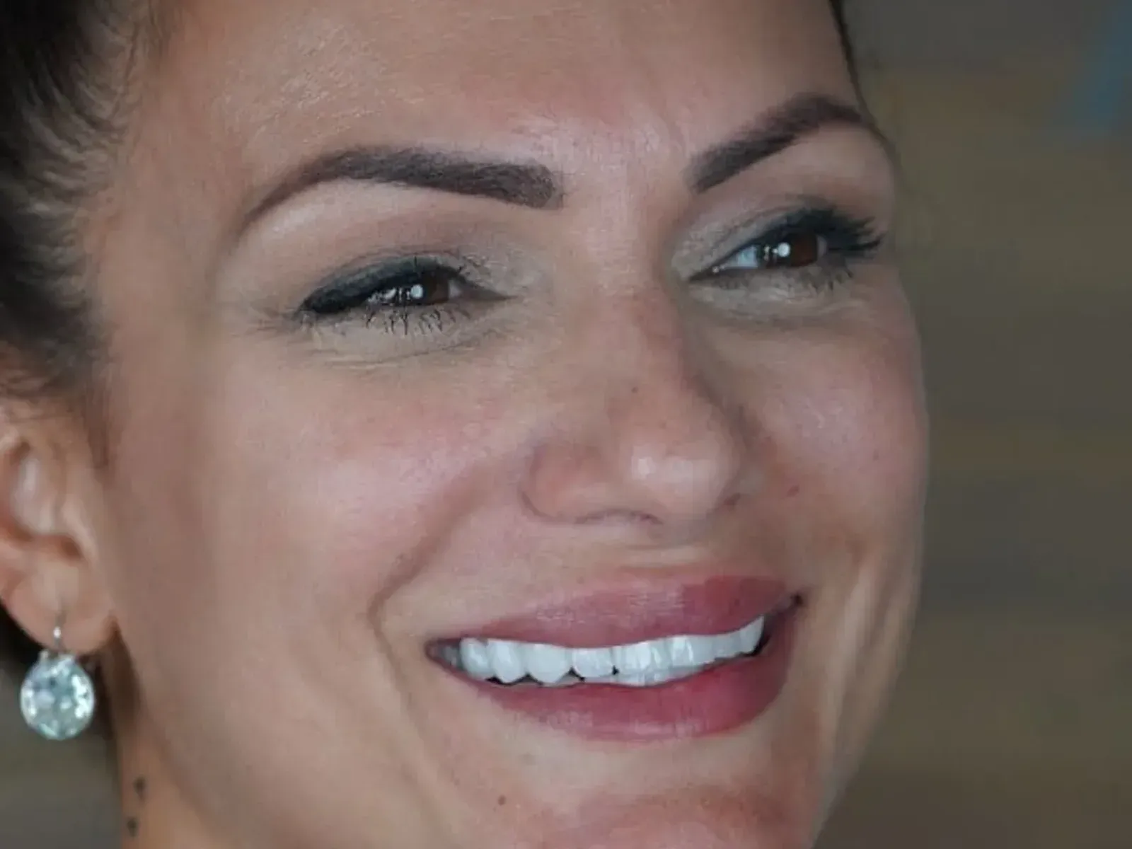Po Hollywood smile — przypadek z naszej kliniki