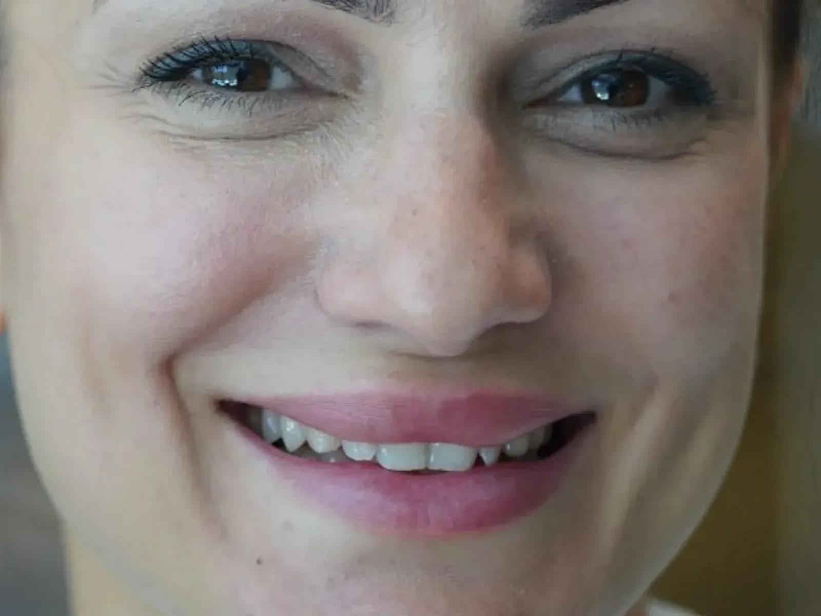 Przed Hollywood smile — przypadek z naszej kliniki