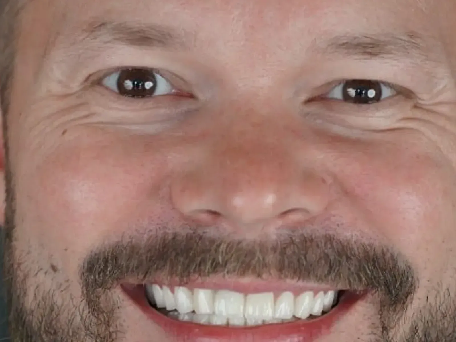 Po Hollywood smile — przypadek z naszej kliniki