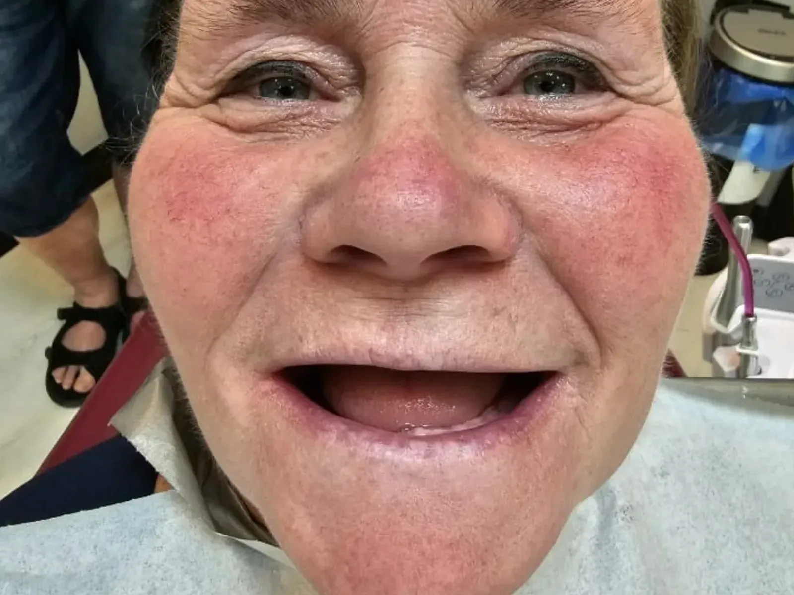Przed Hollywood smile — przypadek z naszej kliniki